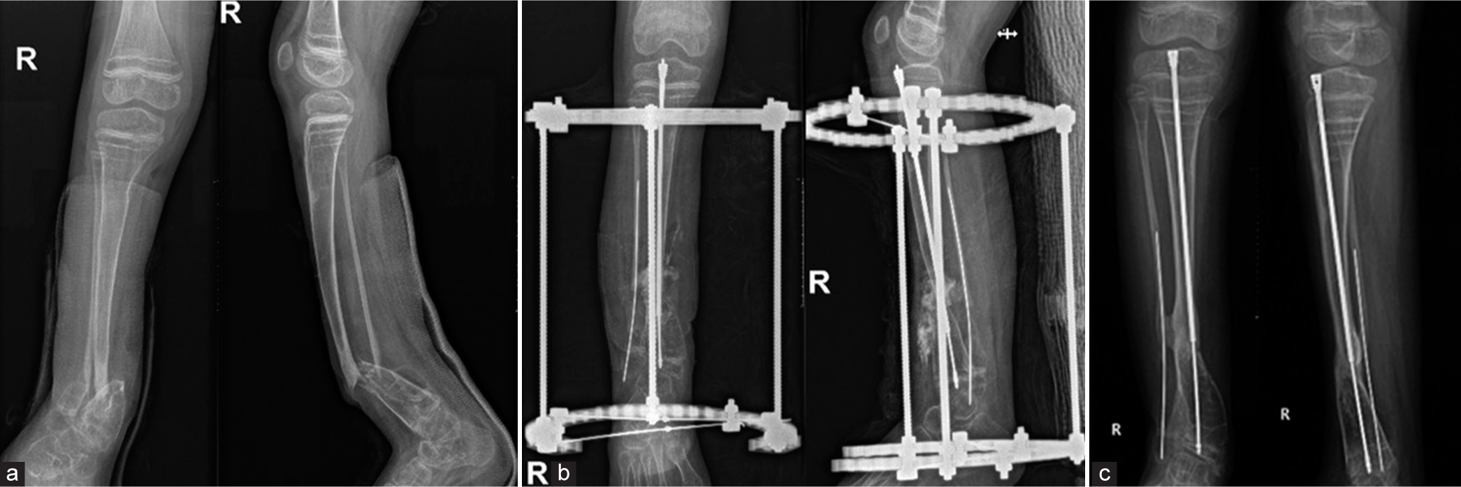 Advancing care for congenital pseudoarthrosis: A case series highlighting the combined use of an intramedullary device with either Ilizarov’s fixators or plating for the treatment of congenital pseudoarthrosis