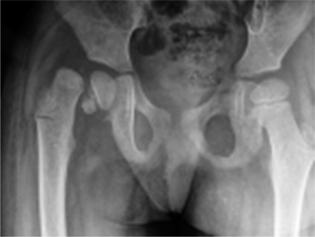 Seizure-related bilateral asynchronous displaced late presenting Delbet type I fractures: A case report and literature review