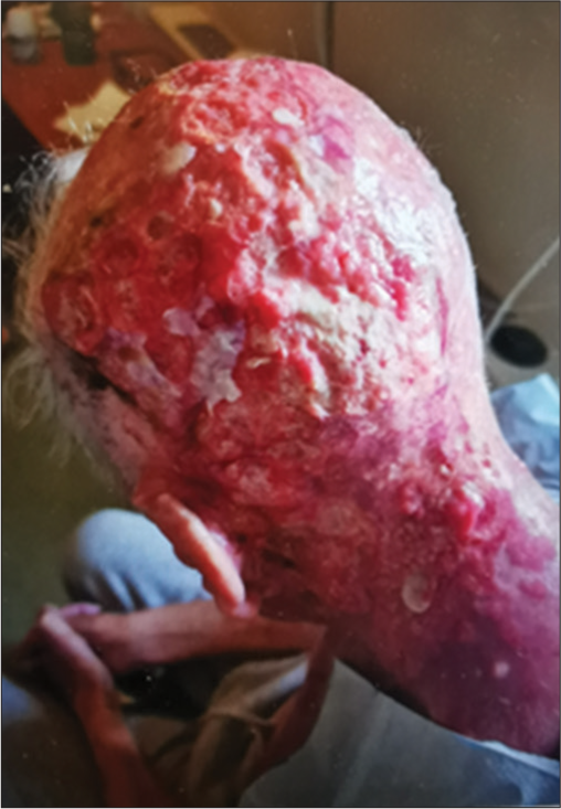 Pain and Wound Management in Fungating Merkel Cell Carcinoma within a Palliative Setting: The First Case Report of this Predicament