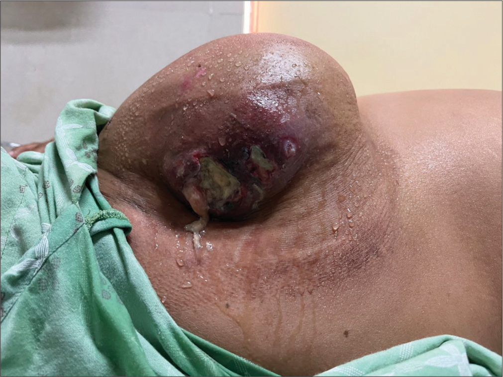 Management of Lymphoedema and Lymphorrhoea with Wrap around Compression in Breast Secondary to Carcinoma Breast: A Case Report