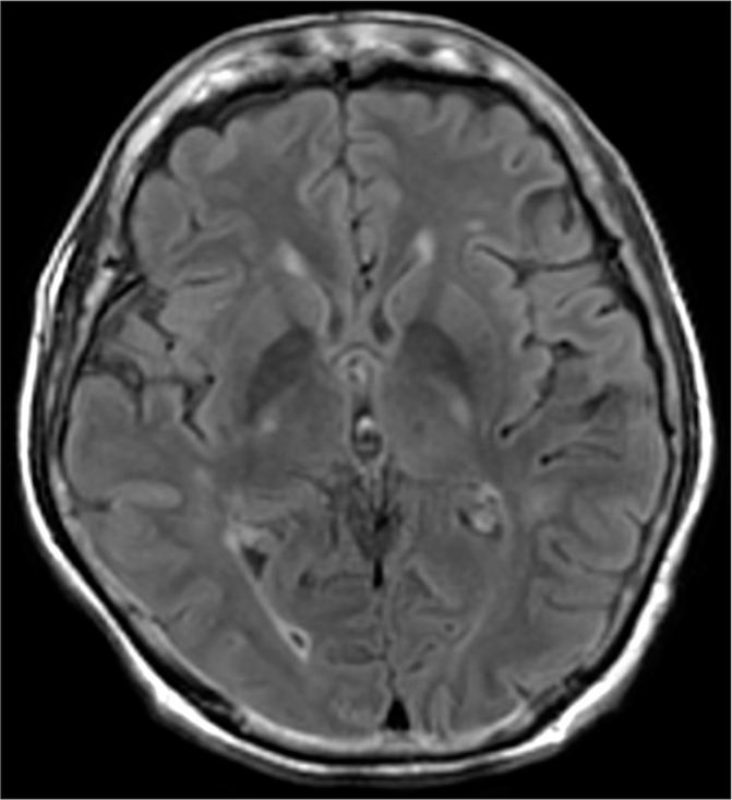 5-Fluorouracil-induced Reversible Encephalopathy
