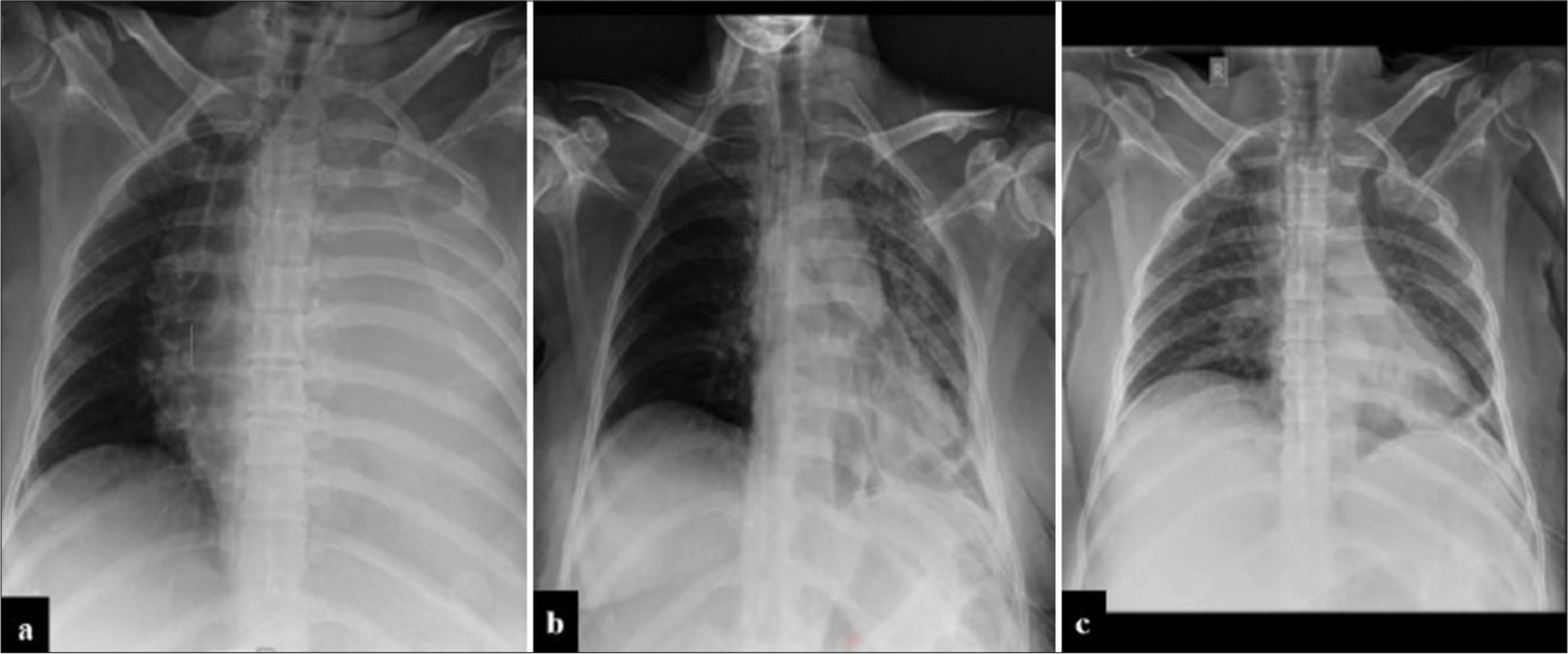 Trocar Catheter: A New Alternative for Point of Care for Management of Pleural Effusion by Palliative Care Physicians