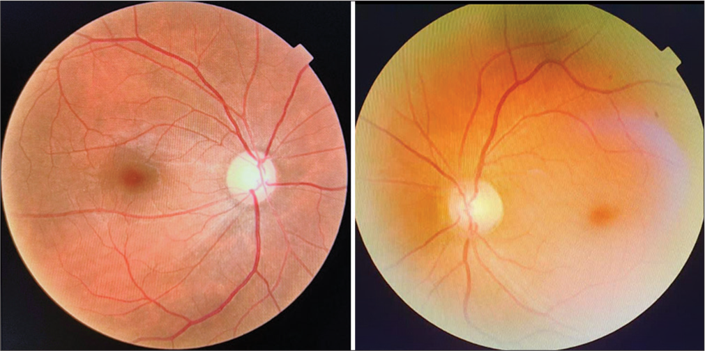 A rare presentation of saccular aneurysm at junction of middle carotid artery and internal carotid artery mimicking the normal tension glaucoma