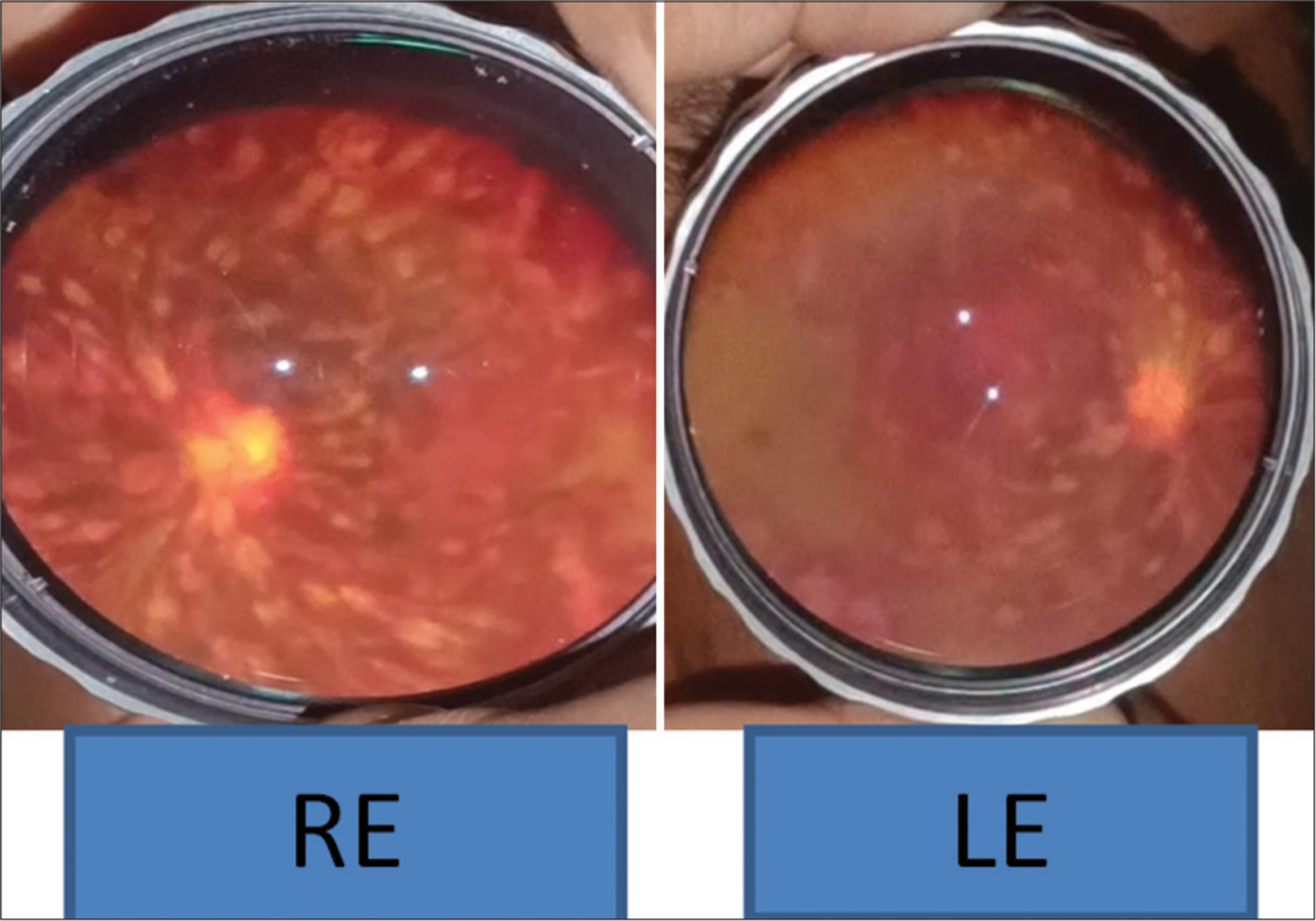 Exploring the kaleidoscope: Ocular manifestations in leukaemia – A case series revelation