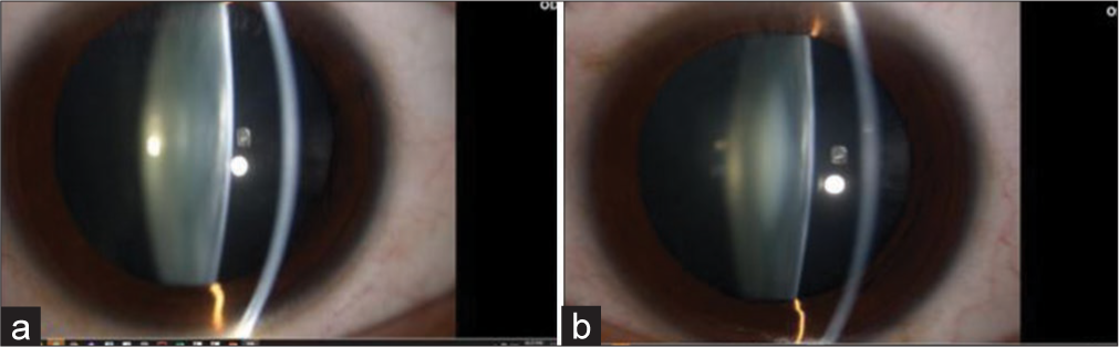 Lenticular progressive myopia in a young male patient