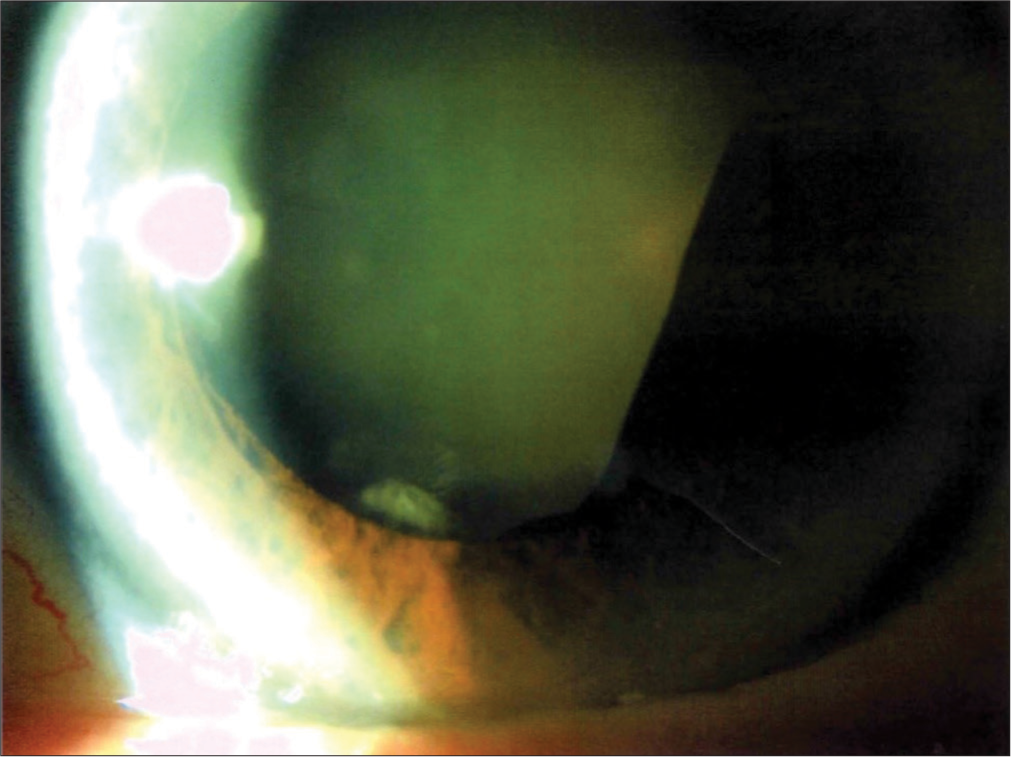 Pseudo-plateau iris secondary to multiple peripheral pigment epithelial cysts: A case report