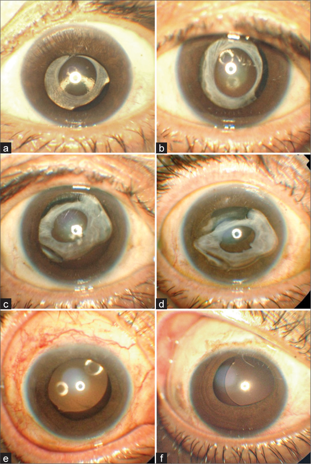 Bilateral spontaneous late anterior dislocation of in-the-bag intraocular lens with phimosis in uveitis patient