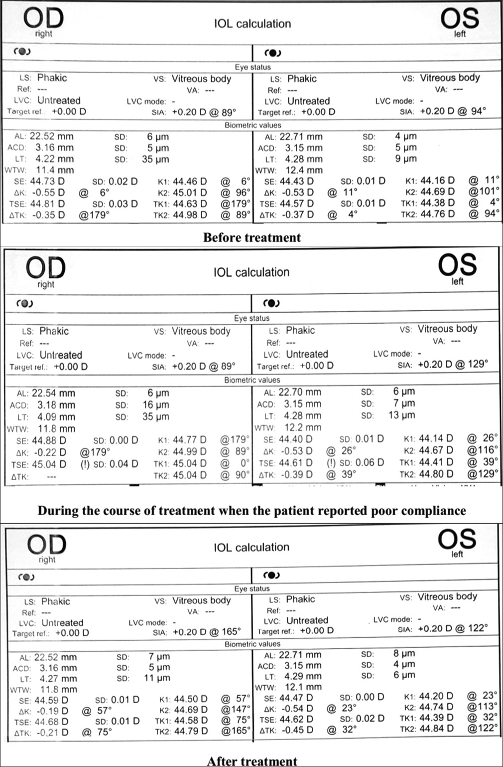 Target emmetropia – Ocular surface stabilisation and achieving refractive success with a new presbyopia-correcting intraocular lens