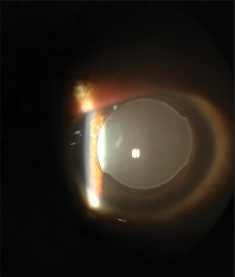 Intraocular lens opacification: An uncommon case scenario