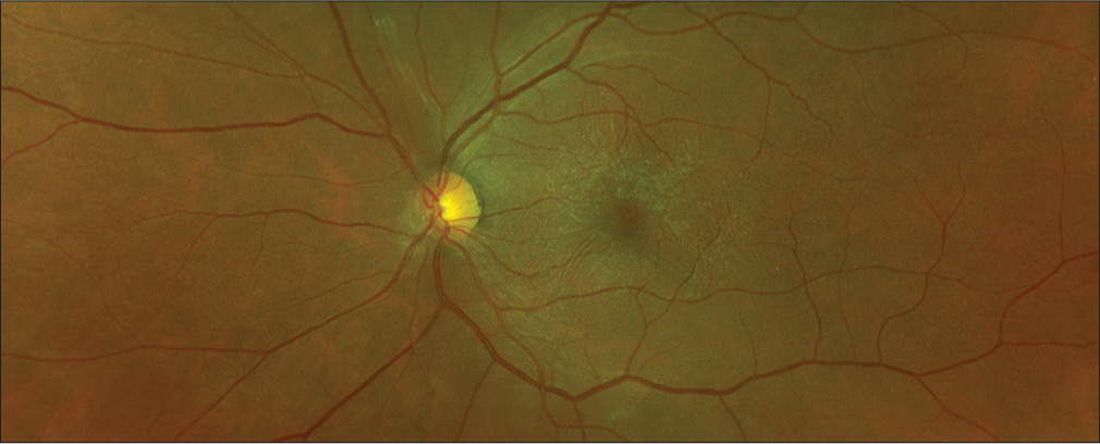 Spontaneous separation of epiretinal membrane – A case report