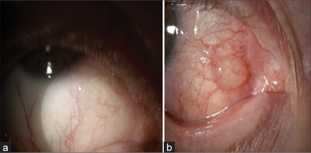 Recurrence of a conjunctival inclusion cyst