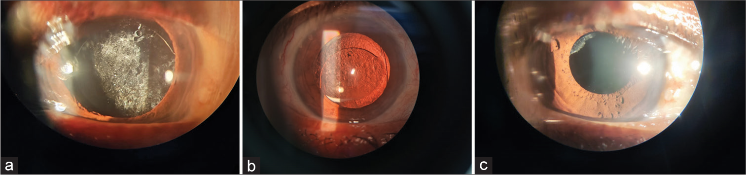 A clinical study of the neodymium-doped yttrium–aluminium–garnet laser posterior capsulotomy: Visual outcome and early complications