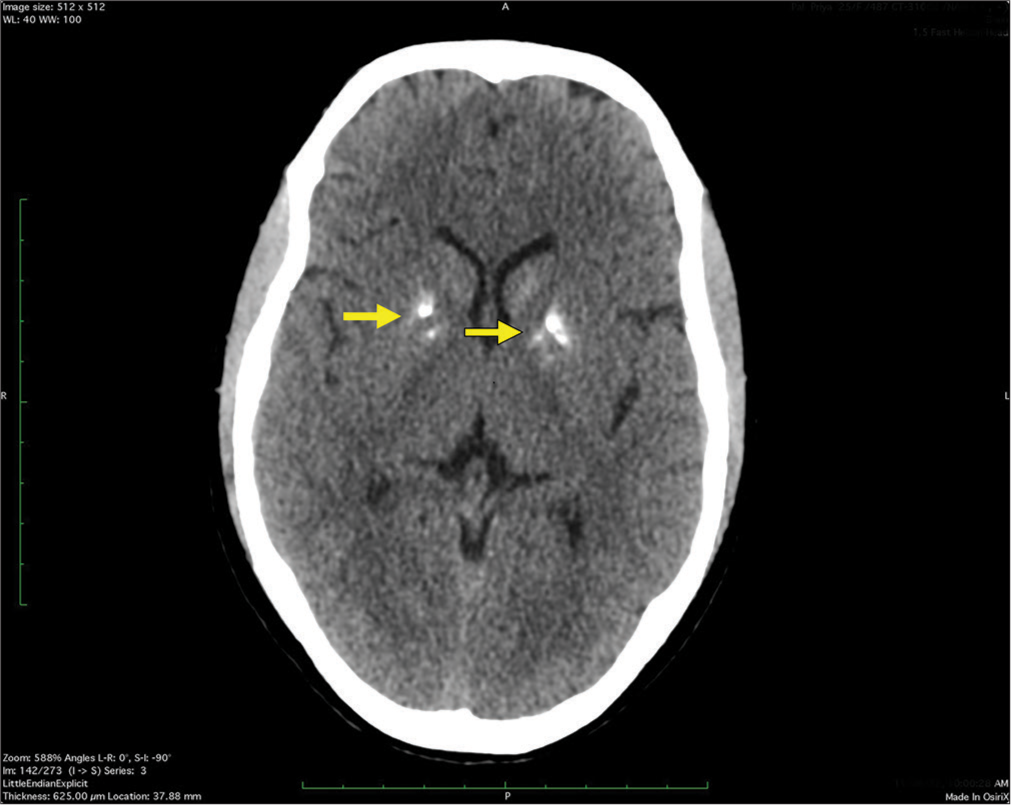 Hypoparathyroidism: A dark horse differential in young age cataracts