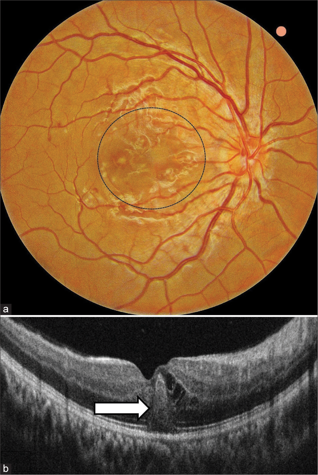 Foveolitis with fever: An optical tomography biomarker for dengue maculopathy