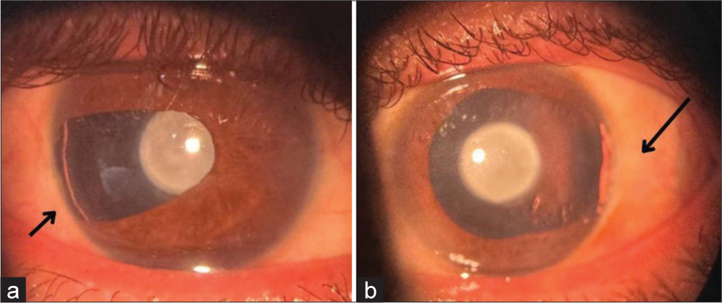 Atypical presentation and treatment of congenital cataract and temporal iridolenticular coloboma in a 43-year-old male