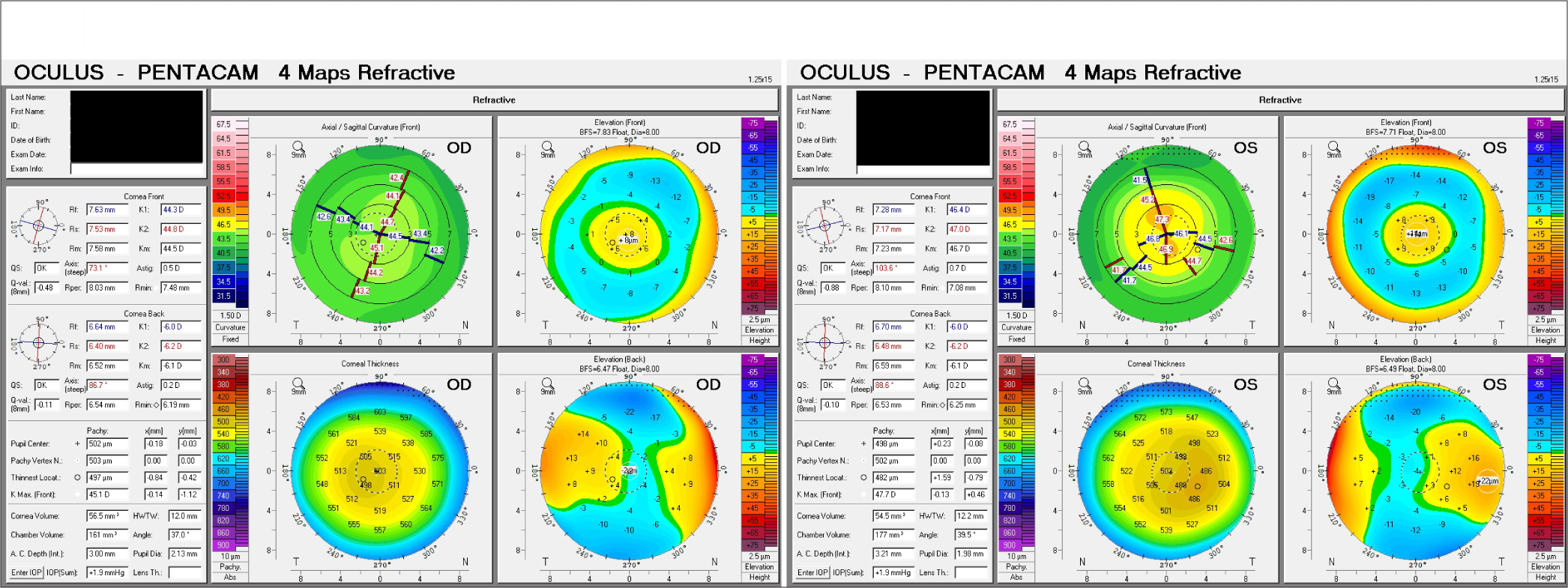 Bilateral cataract monovision surgery in a 54-year-old woman following Presbyond laser-blended vision: A case report