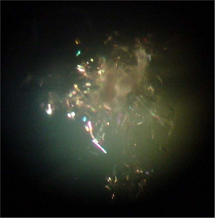 Christmas tree cataract: A rare association with gout!