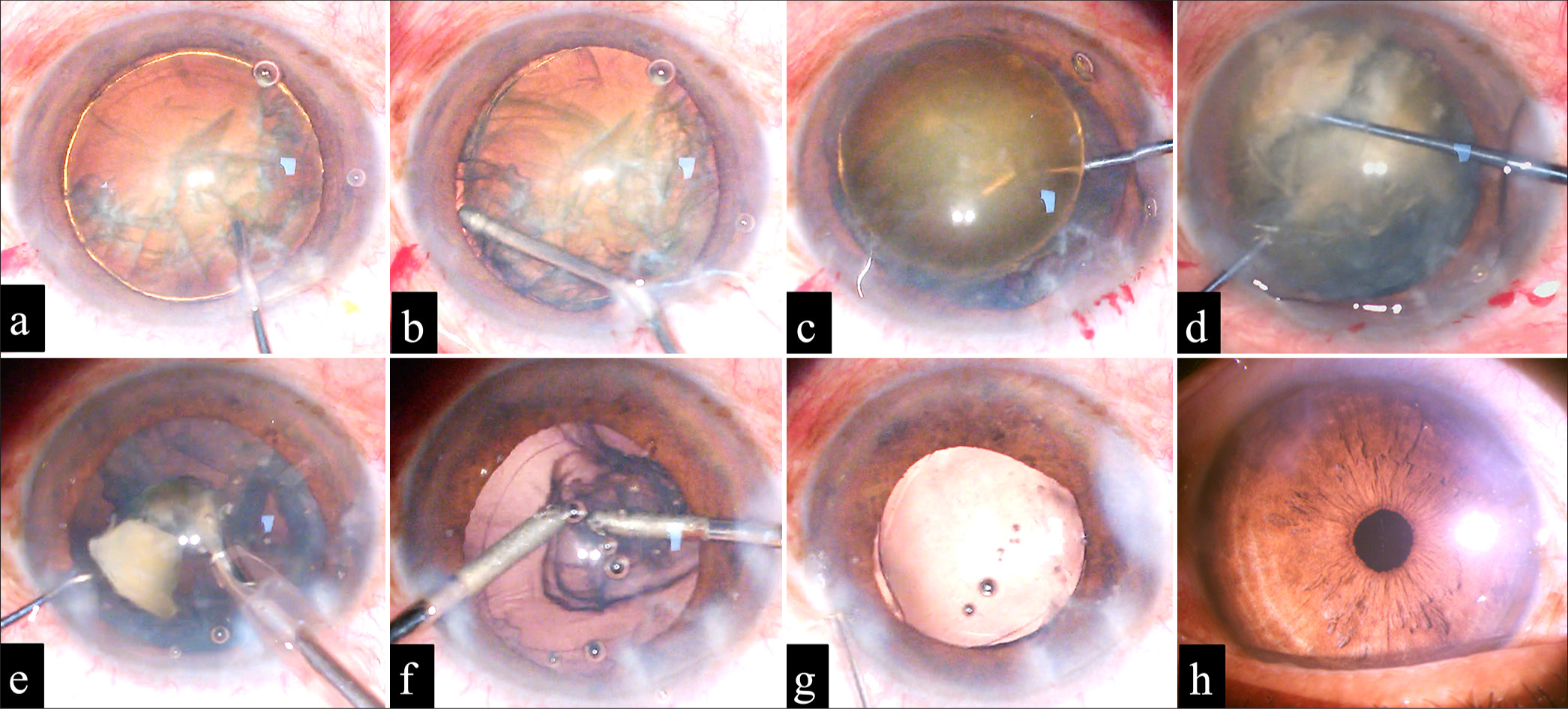A simple and safe approach of phacoemulsification cataract surgery in hard brown cataracts with different complexities using the Two-Y crushing technique: A report of two cases