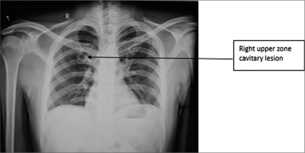 Distinct Profiles of Pulmonary Embolism: Insights from a Case Series