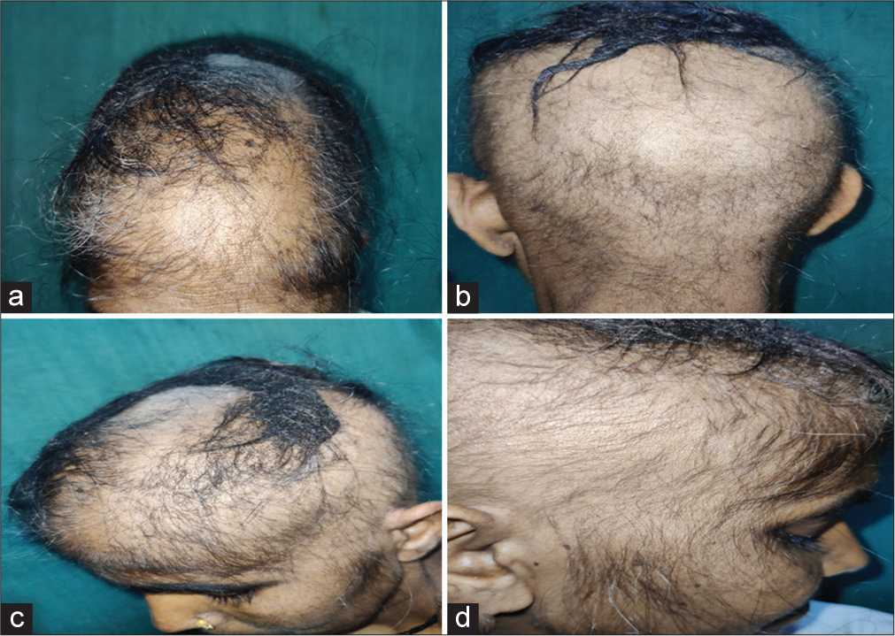 Azathioprine-Induced Anagen Effluvium: A Case Series of Three Cases