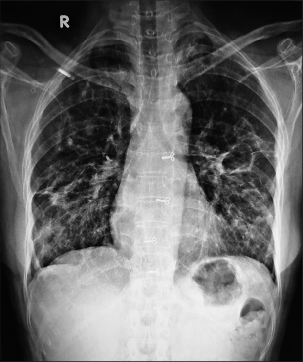 A Case Report on Granulomatosis with Polyangitis and Diffuse Alveolar Haemorrhage