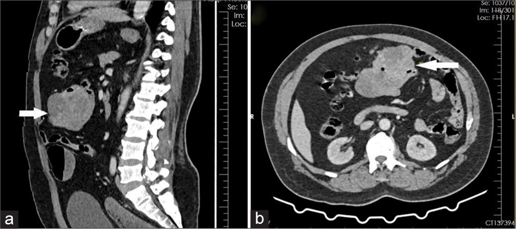 Jejunal Gastrointestinal Stromal Tumour Presenting with Profound Lower Gastrointestinal Bleeding