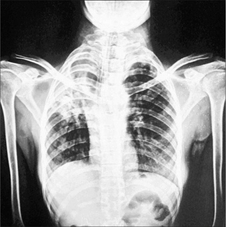 Long-term Sequelae: Sheehan’s Syndrome Unveiled 12 Years Postpartum Haemorrhage Complicated by Pulmonary Tuberculosis – A Clinical Case Report