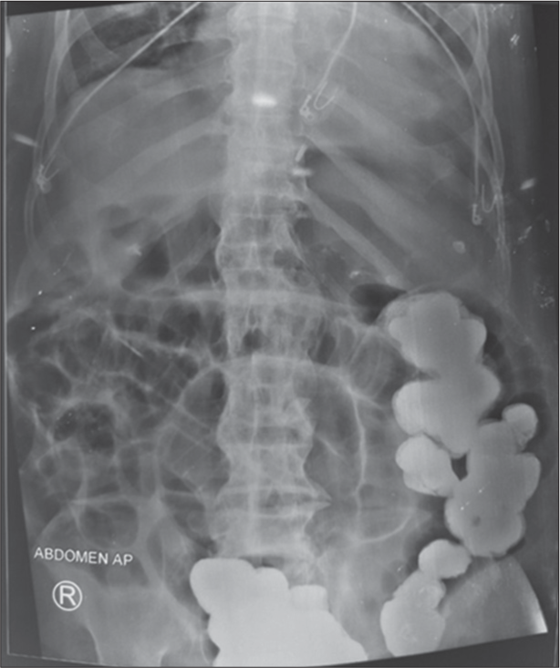 Intestinal Obstruction Following Barium Swallow