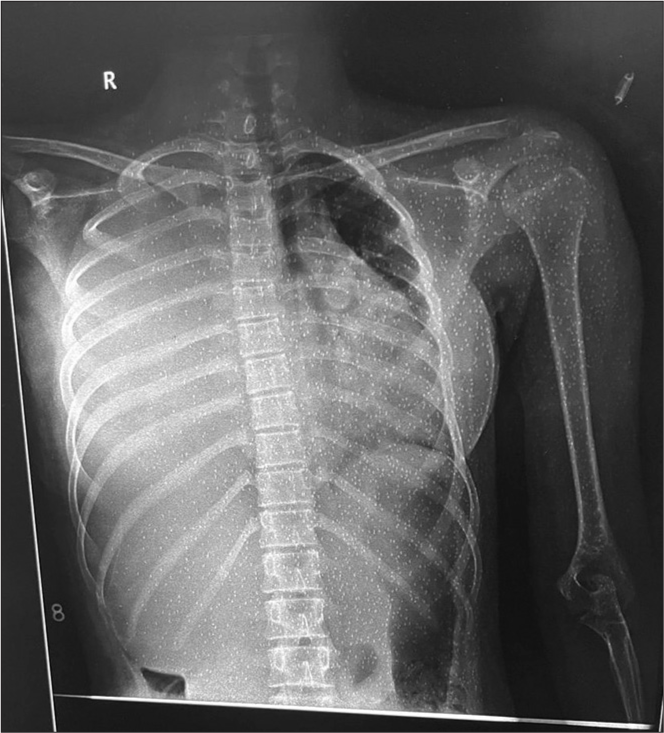 Opaque Hemithorax in a Young Girl: A Rare Case of Askin’s Tumour