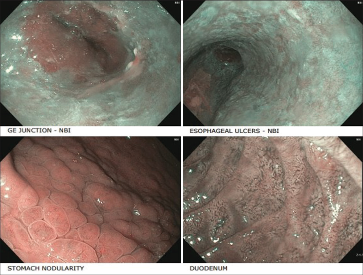 A Case of Herpes Simplex Oesophagitis