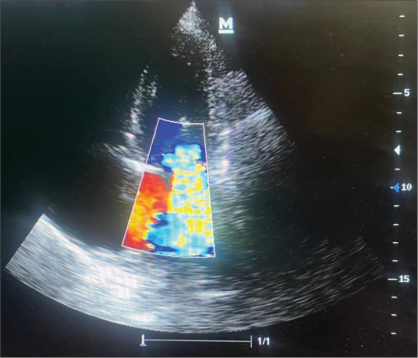 Severe Mitral Regurgitation: A Rare Manifestation of Chemotherapy-Induced Cardiotoxicity