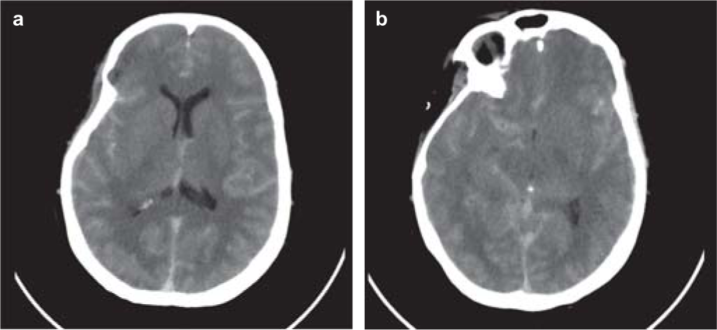 Pseudo-subarachnoid haemorrhage: An unusual presentation of hyperviscosity syndrome