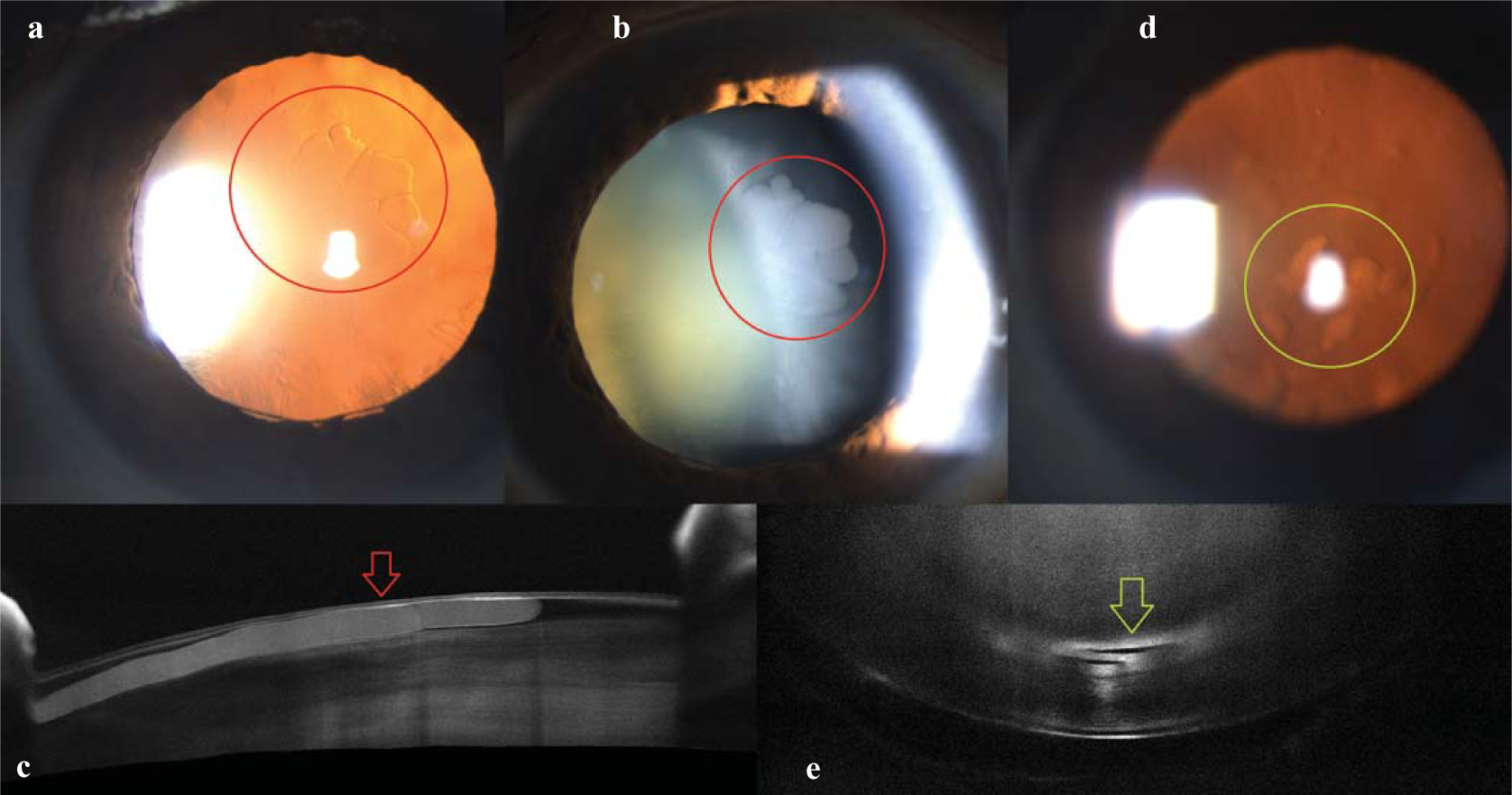 Cortical versus nuclear lenticular fluid