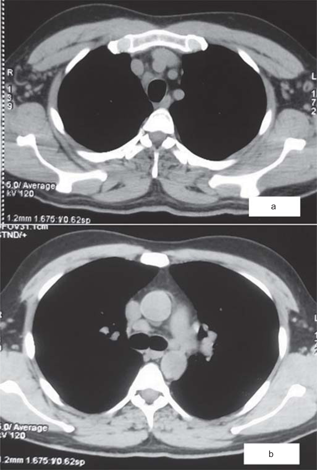 Haemophagocytic lymphohistiocytosis post-ChAdOx1 nCoV-19 vaccine: A rare case