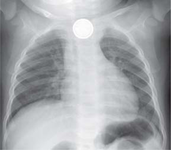 Tracheo-oesophageal fistula by ingestion of a lithium battery