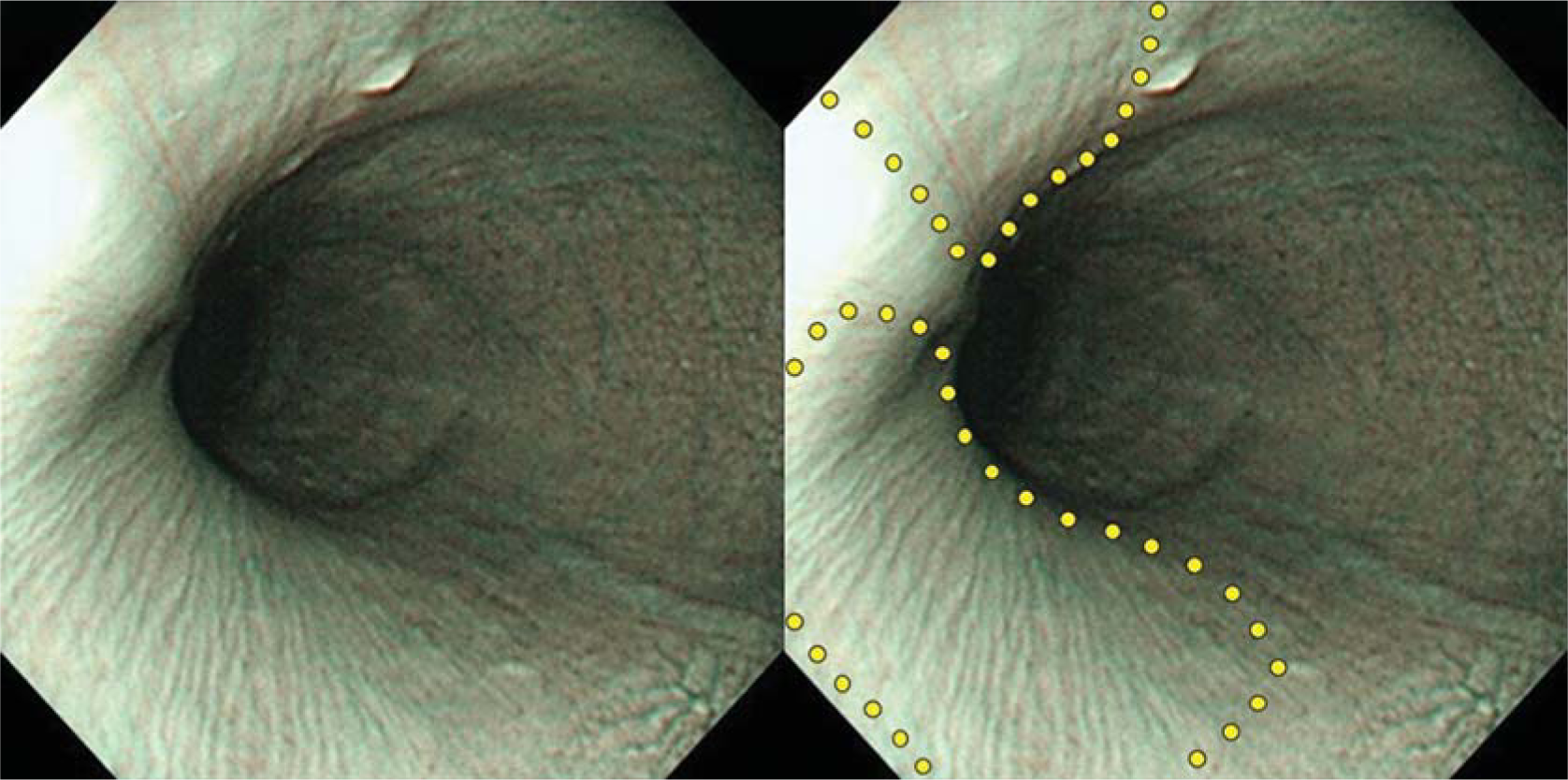 Achalasia: Pinstripe pattern