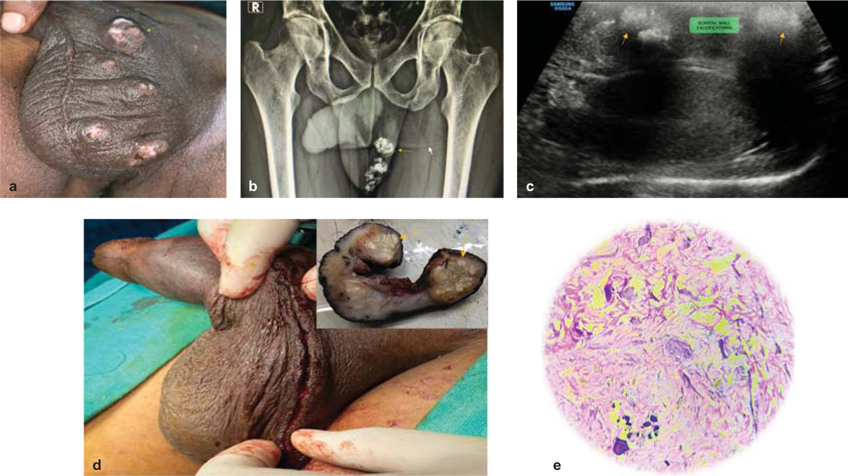 Idiopathic calcinosis cutis of scrotum