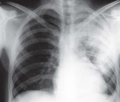 Scrub typhus presenting with massive splenomegaly and lobar pneumonia