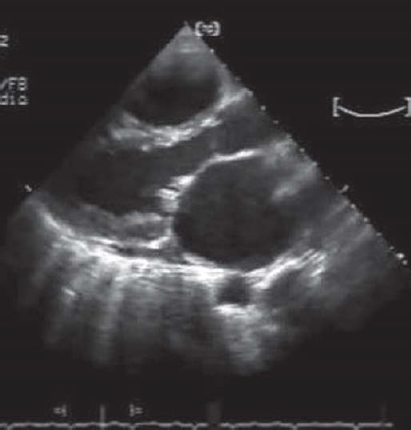 Scrub typhus presenting as mitral valve infective endocarditis