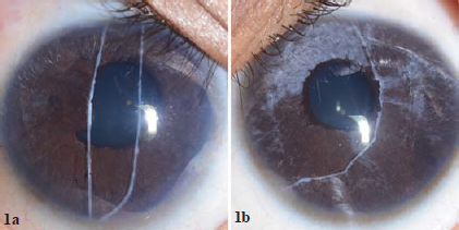 Detached Schwalbe line in Axenfeld–Rieger syndrome