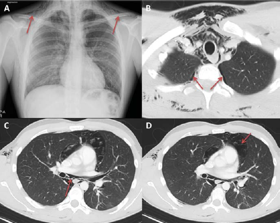 Macklin effect: Spontaneous pneumomediastinum caused by marijuana