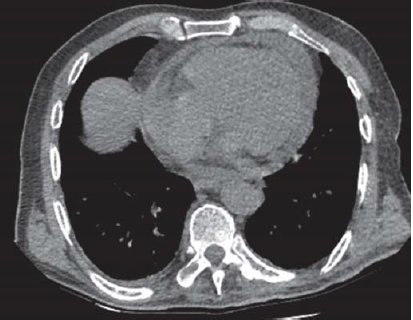 Endobronchial ultrasound guided transbronchial needle aspiration leading to cardiac empyema and tamponade by Prevotella oris