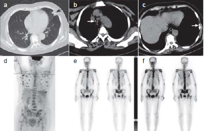 Rapid diagnosis of disseminated Mycobacterium avium complex infection mimicking metastatic malignancy using metagenomic next-generation sequencing
