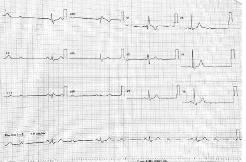 Isolated heart block in snake bite: Recurrent syncope as presenting symptom