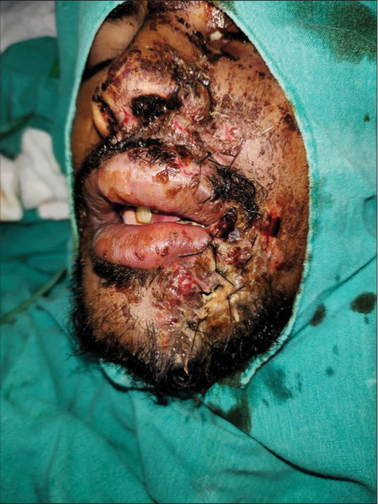 Unmasking the face: A case report of soft-tissue reconstruction after degloving injury