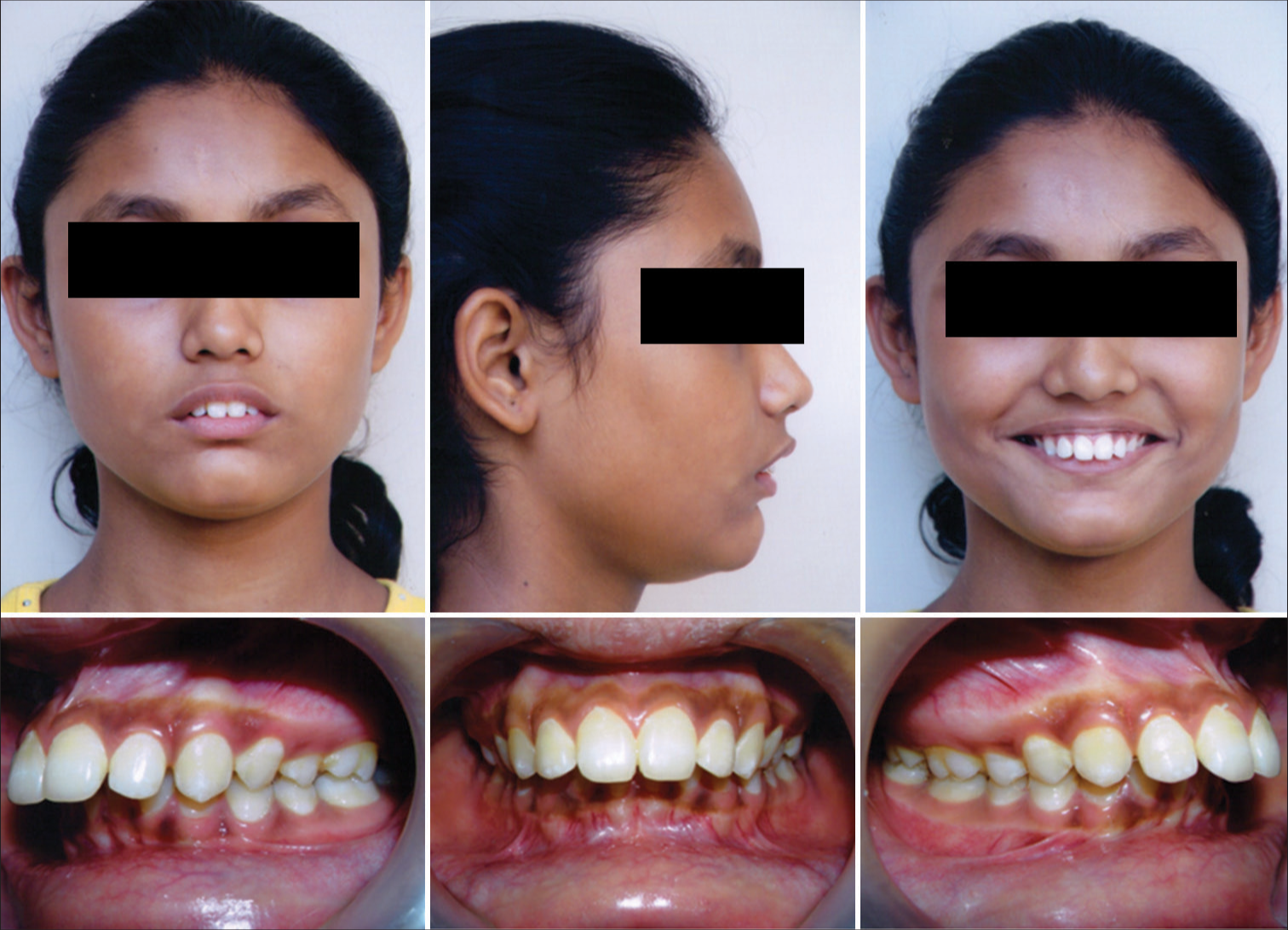 Treatment of non-compliant skeletal class II malocclusion with a hybrid appliance – A case report and review literature