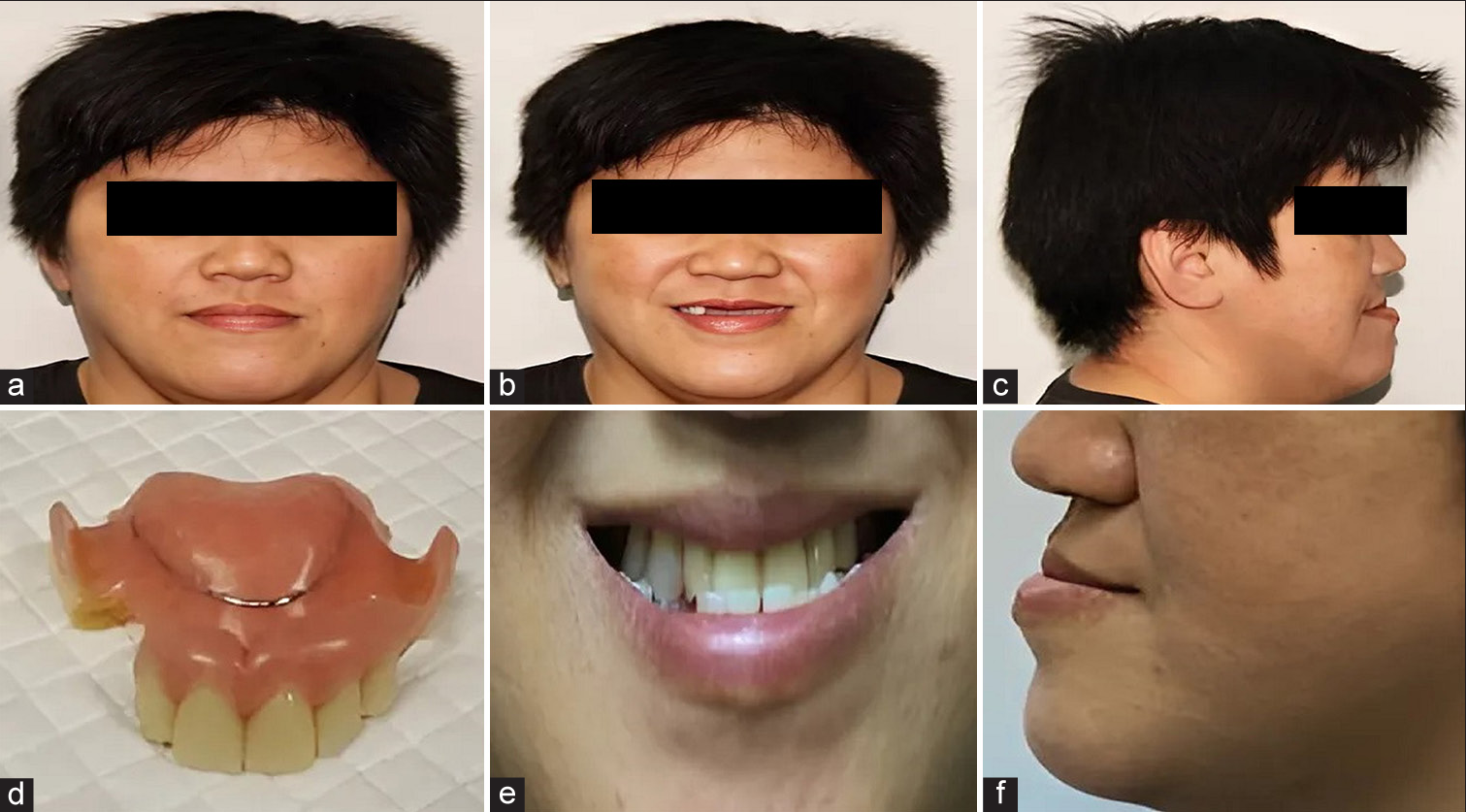 Removable overlay dentures: A possible esthetic alternative for the prosthodontic management of partially edentulous skeletal class-3 malocclusions