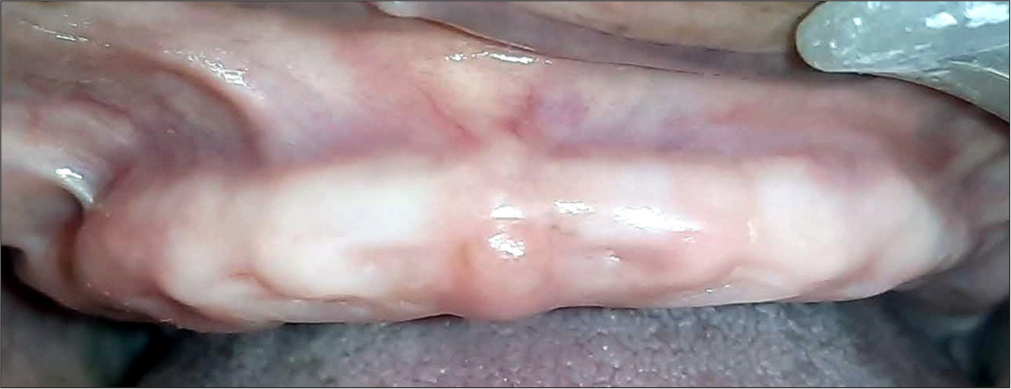 Wing denture: A prosthodontic approach to complete dentures for prominent labial ridges