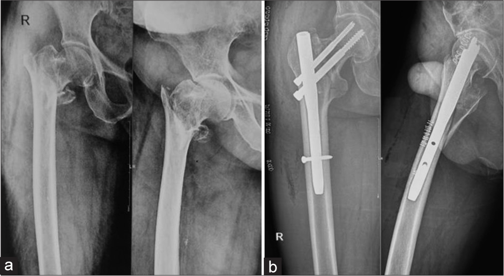 A comparative study of proximal femoral nail and dynamic hip screw for intertrochanteric fractures of the femur