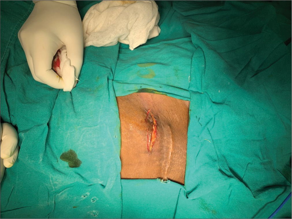 Abdominal wall endometriosis: A rare case report